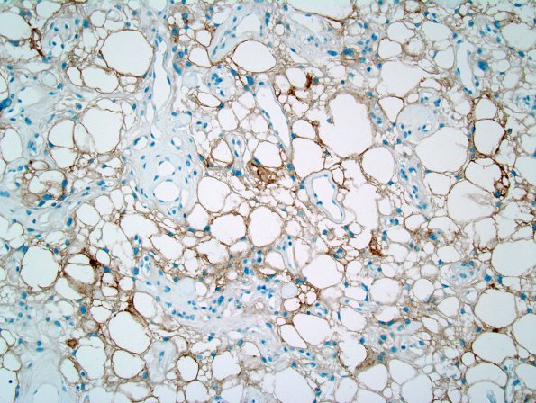 9C1 Meningioma, Microcystic Angiomatous (Case 9) EMA 1.jpg