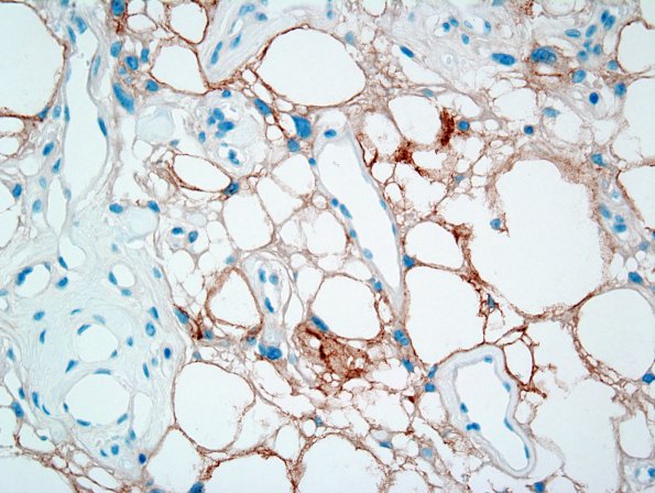 9C2 Meningioma, Microcystic Angiomatous (Case 9) EMA 2.jpg