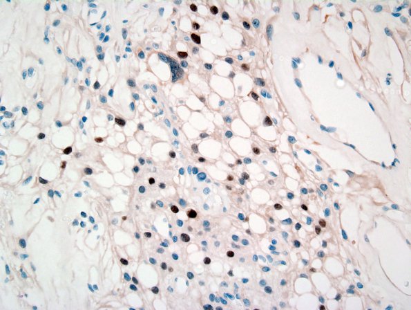 9D1 Meningioma, Microcystic Angiomatous (Case 9) PR 1.jpg