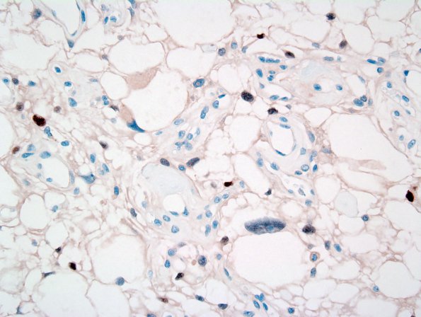 9D2 Meningioma, Microcystic Angiomatous (Case 9 PR 2.jpg