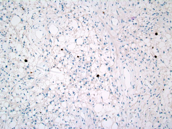 9E Meningioma, Microcystic Angiomatous (Case 9) Ki-67 1.jpg