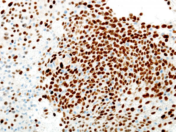 2A10 Meningioma, atypical (Case 7) PR