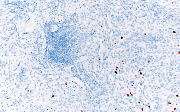 2A13 Meningioma, atypical (Case 8) Ki67 1