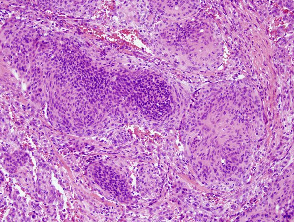 2A2 Meningioma, atypical (Case 3) H&E 1