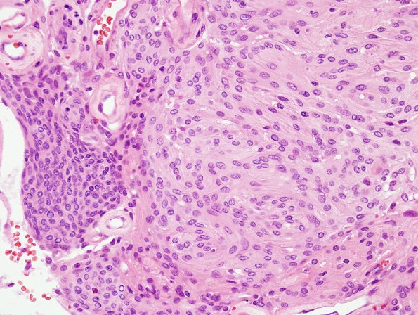 2A3 Meningioma, atypical (Case 4) H&E 1