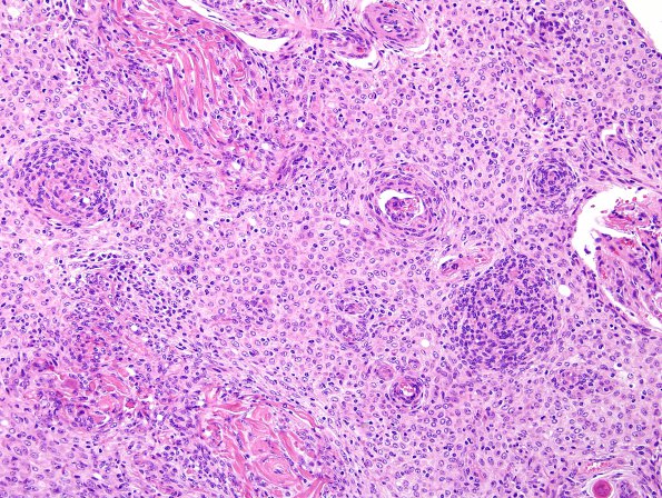 2A4 Meningioma, atypical intraventricular (Case 5) H&E 2