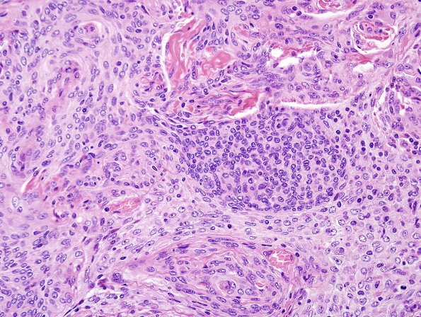 2A5 Meningioma, atypical intraventricular (Case 5) H&E 4