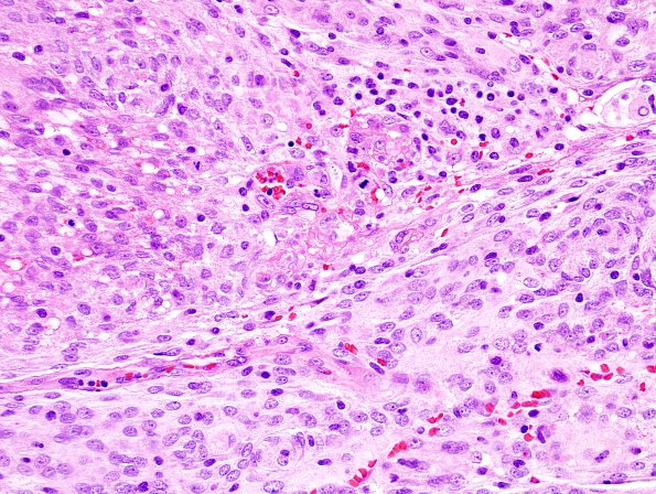 2B1 Meningioma, atypical (Case 9) H&E 1