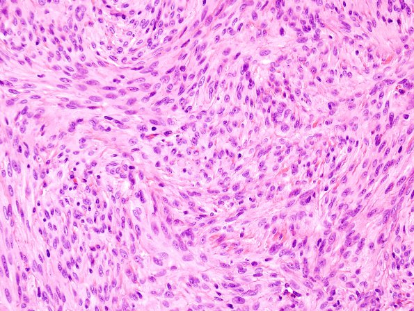 2B3 Meningioma, atypical (Case 11) Nucleoli H&E 1