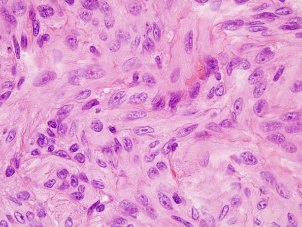 2B4 Meningioma, atypical (Case 11) Nucleoli H&E 2