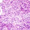 2B6 Meningioma, atypical intraventricular (Case 5) H&E 11