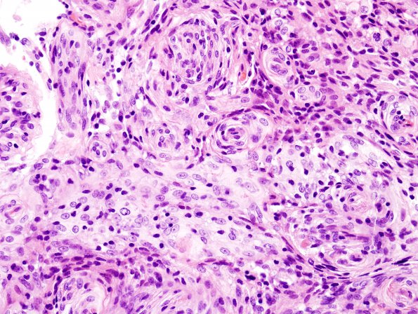 2B6 Meningioma, atypical intraventricular (Case 5) H&E 11