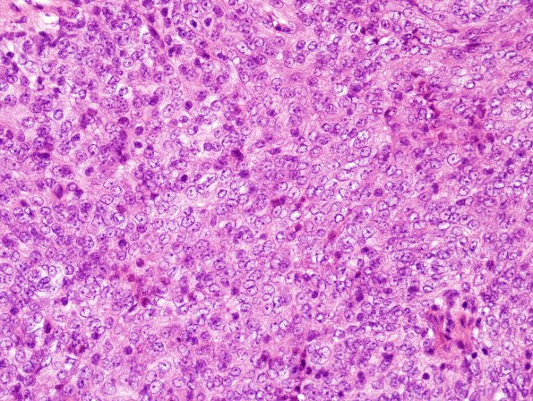 2B7 Meningioma, atypical WHO II (Case 13) H&E 4.jpg