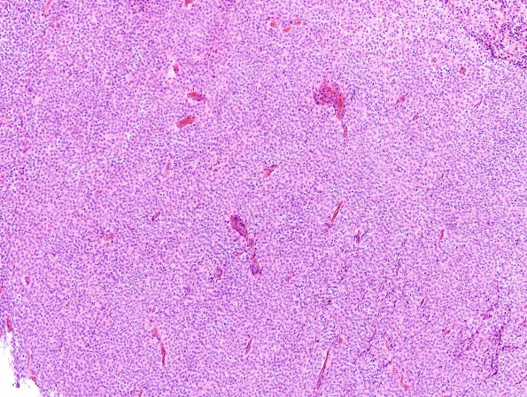 2C1 Meningioma, atypical (Case 14) H&E 1