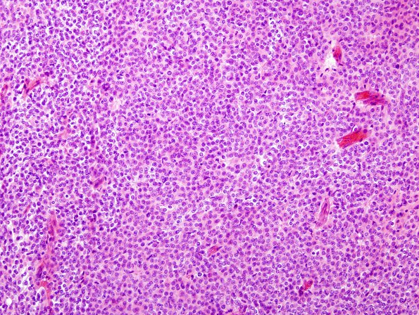 2C2 Meningioma, atypical (Case 14) H&E 2