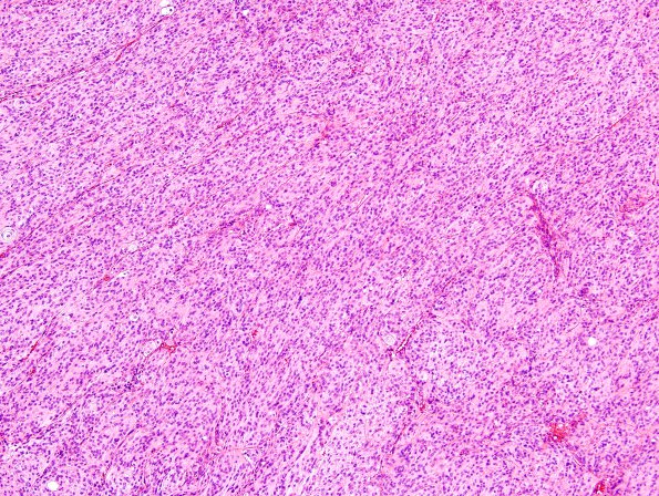 2C3 Meningioma, atypical (Case 12) H&E 7