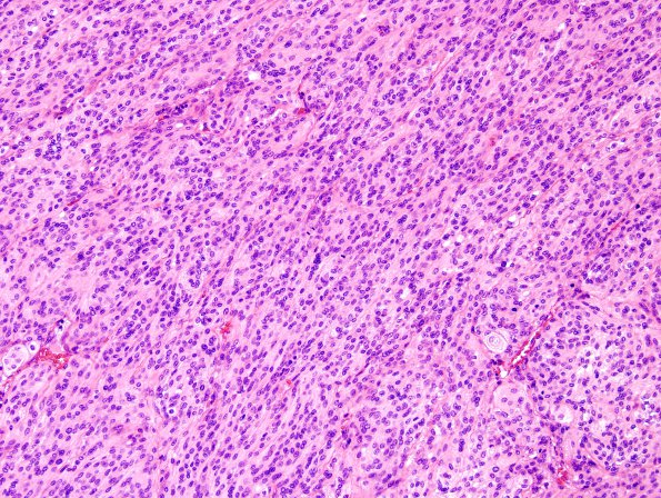 2C4 Meningioma, atypical (Case 12) H&E 8