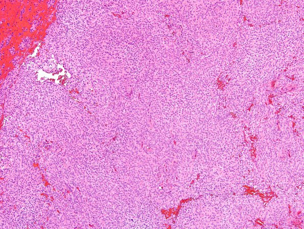 2C5 Meningioma, atypical, WHO II (Case 12) H&E 1