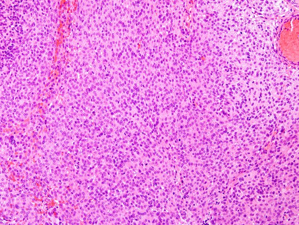 2C6 Meningioma, atypical (Case 15) H&E 12.jpg