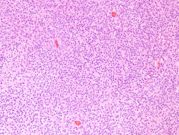 2C7 Meningioma, atypical, WHO II (Case 12) H&E 5