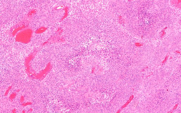 2D1 Meningioma, atypical (Case 16) H&E 3