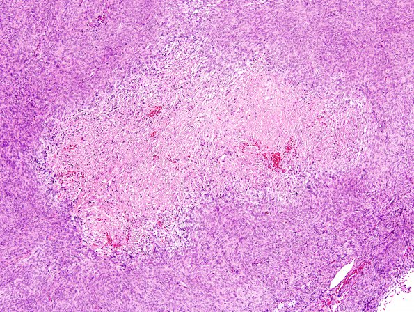 2D2 Meningioma, Atypical (Case 17) H&E 4