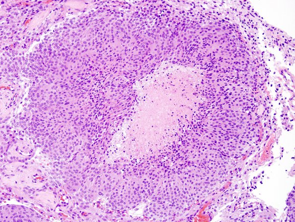 2D3 Meningioma, atypical (Case 18) H&E 2