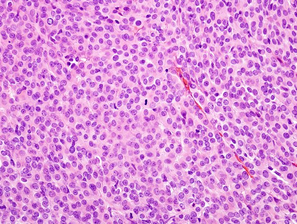 2E2 Meningioma, atypical (Case 14) H&E 3