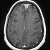 3A2 Meningioma, atypical (Case 3) T1 with C