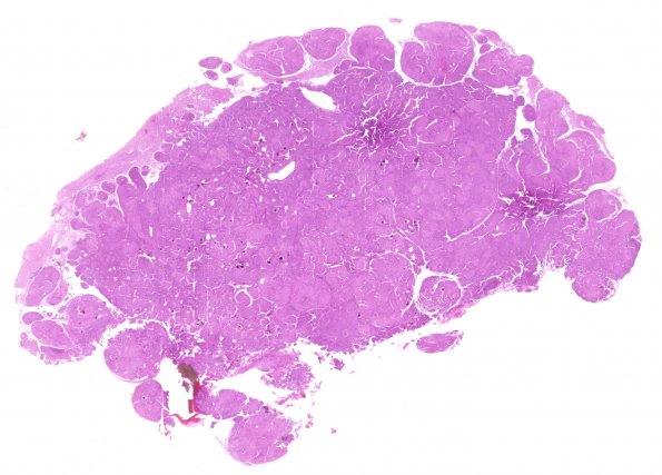 10A1 Meningioma, brain invasion (Case 10) H&E WM