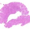 10A2 Meningioma, brain invasion (Case 10) H&E WM 2