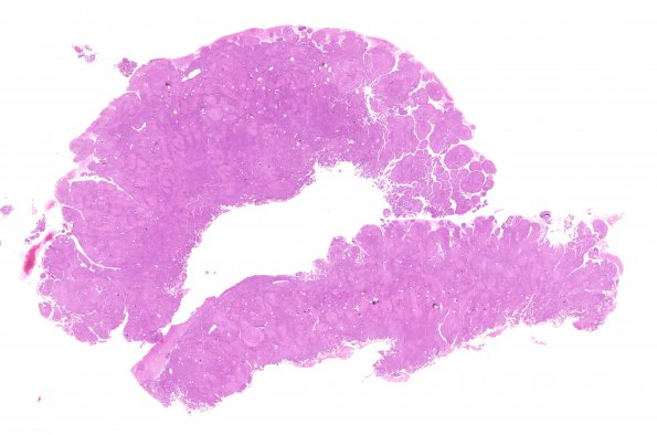 10A2 Meningioma, brain invasion (Case 10) H&E WM 2