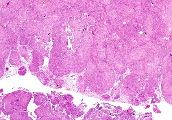 10A3 Meningioma, brain invasion (Case 10) H&E 3.jpg