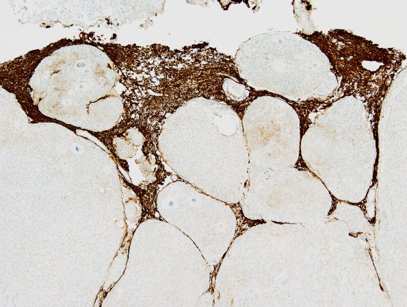 10C2 Meningioma, brain invasion (Case 10) GFAP 1.jpg