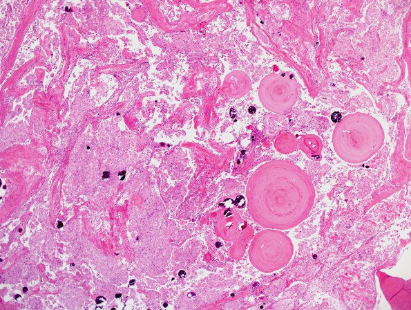 11A1 Meningioma, brain invasion, unusual (Tx Hunter Cai, Case 11) H&E 6.jpg