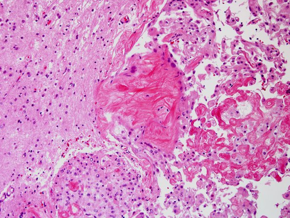 11A2 Meningioma, brain invasion, unusual (Tx Hunter Cai, Case 11) H&E 9.jpg