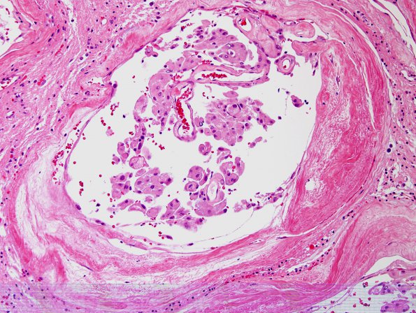 11A3 Meningioma, brain invasion, unusual (Tx Hunter Cai, Case 11) H&E 12.jpg