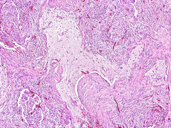 12A1 Meningioma, brain invasion (Case 12) H&E 2.jpg