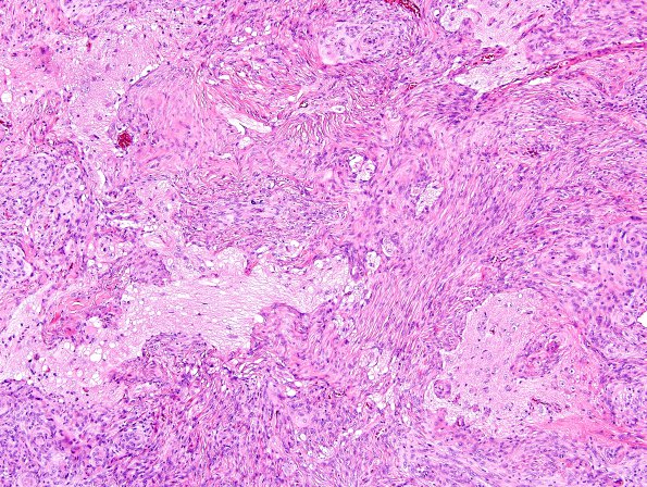 12A2 Meningioma, brain invasion (Case 12) H&E 7.jpg