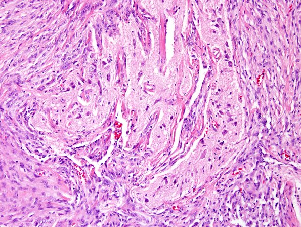 12A3 Meningioma, brain invasion (Case 12) H&E 1.jpg