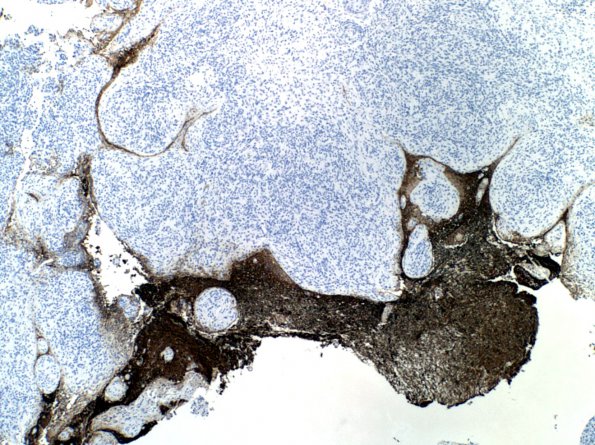 13A1 Meningioma, Brain invasion (Case 12) GFAP