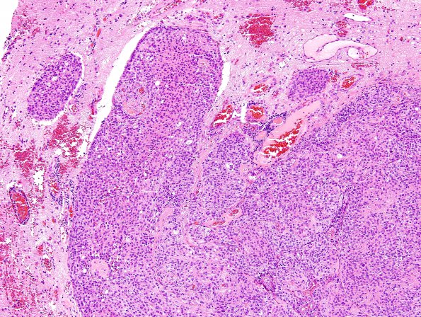 14A Meningioma, brain invasion WHO-II (Case 14) H&E 6