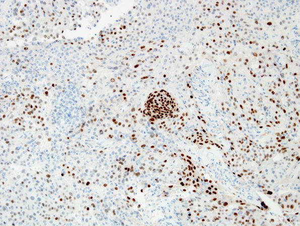 14B Meningioma, brain invasion WHO-II (Case 14) PR 1