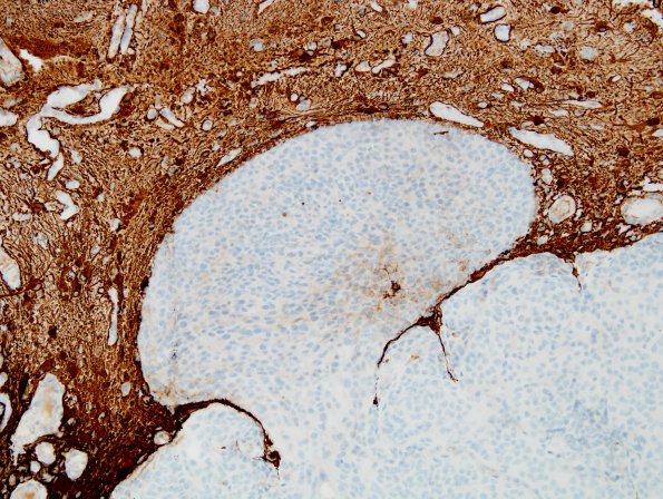 14C2 Meningioma, brain invasion WHO-II (Case 14) GFAP 2