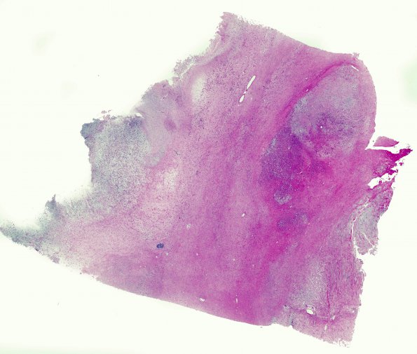 15A1 Meningioma, chordoid with brain invasion, WHO II H&E whole mount