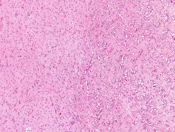 15A2 Meningioma, chordoid with brain invasion, WHO II H&E 2.jpg