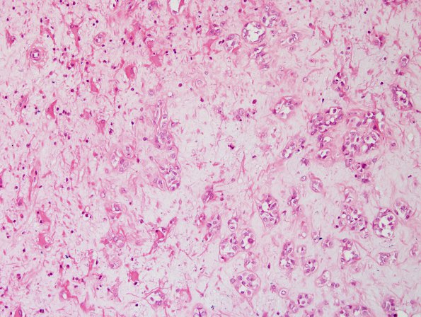 15A3 Meningioma, chordoid with brain invasion, WHO II H&E 4.jpg