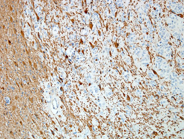 15B2 Meningioma, chordoid with brain invasion, WHO II GFAP 3.jpg