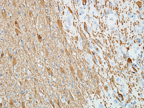 15B3 Meningioma, chordoid with brain invasion, WHO II GFAP 2.jpg