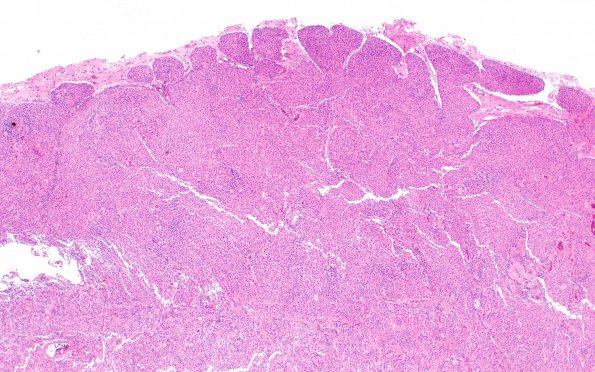 16A1 Meningioma, Grade II Brain invasion (Case 16) H&E 4X 2